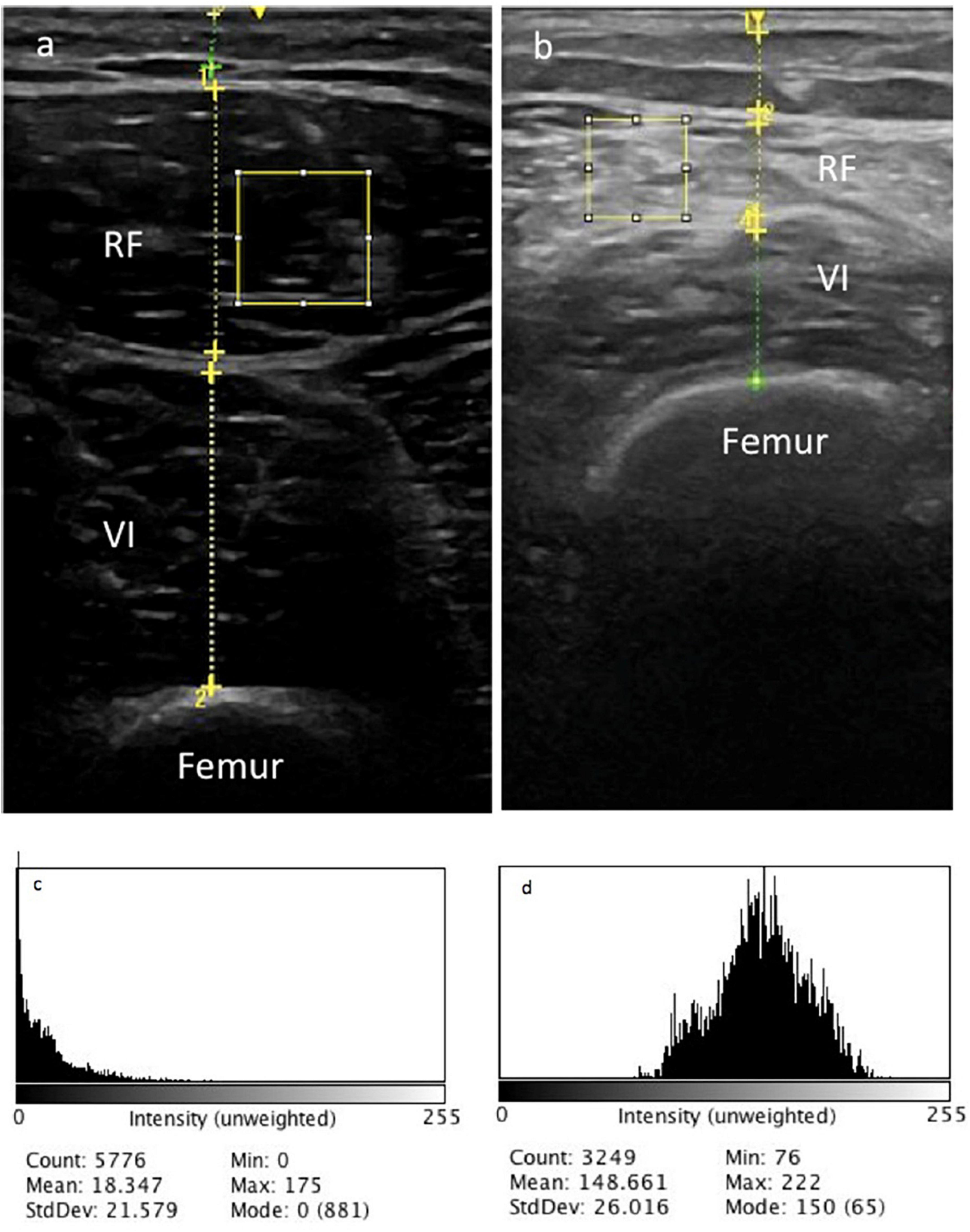 Ultrasonographic findings in long COVID: A cross-sectional study of 312 patients